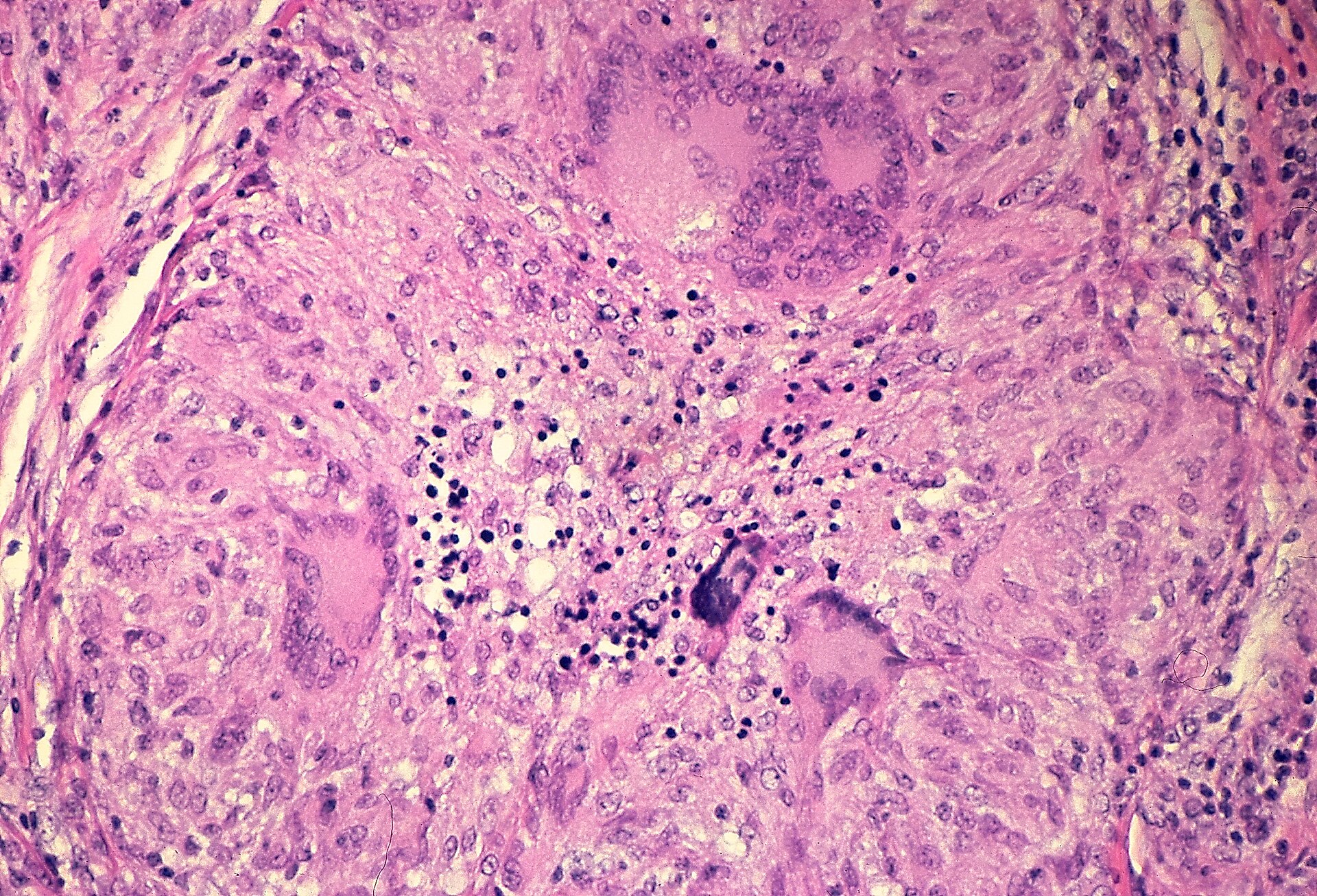 Imagem de referência de tuberculose pulmonar, descrito nos dados abertos como doença humana
