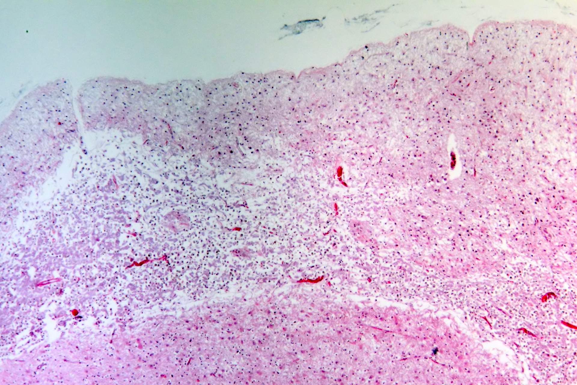 Imagem de referência de Infarto cerebral, descrito nos dados abertos como bloqueio de sangue ou O² ao cérebro