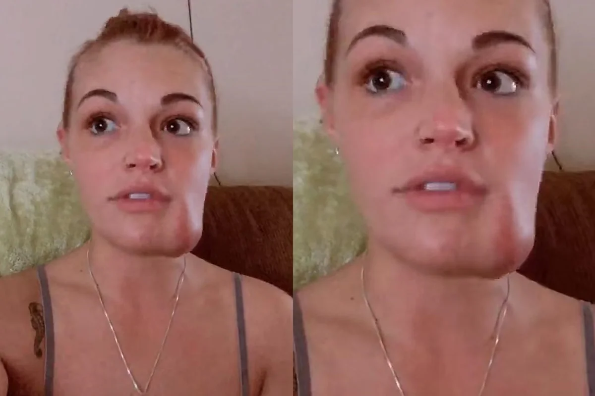 Mulher tenta espremer “espinha” e descobre tumor vascular no rosto